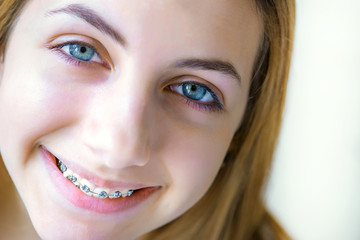 Fototapeta premium Teeth with braces.