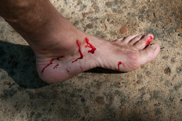 Man's bloody foot © ggaallaa