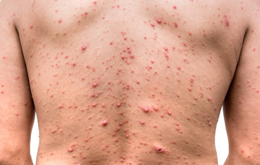 Back side of a man who having varicella blister or chickenpox ,isolated on white