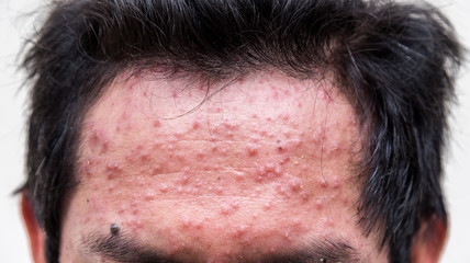forehead of a man who having varicella blister or chickenpox ,isolated on white