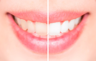 Close-up teeth female between before and after brush the teeth,