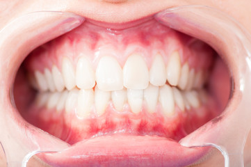 Close up of woman cavity protected by retractor