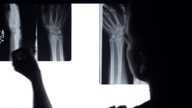 Doctor analyse x rays broken bones. Doctor looking at x-rays of broken wrist in illuminated panel.