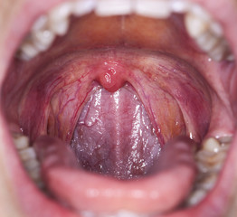 Naklejka premium throat tonsil