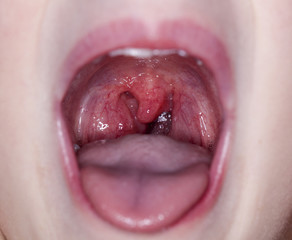 throat tonsil