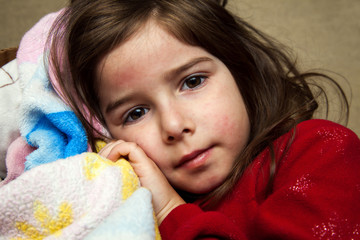 Young Girl With a Fever Rash