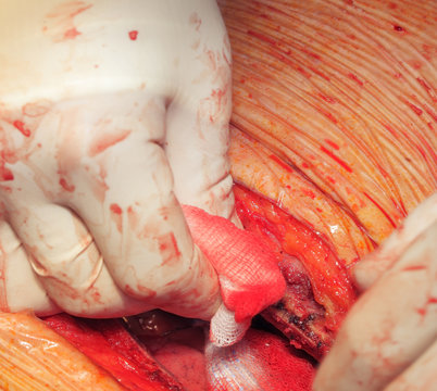 Stop the bleeding during surgery