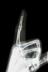 film x-ray index finger and hand ( point a finger )
