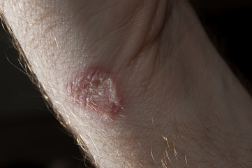 Ringworm on white man / Mycosis