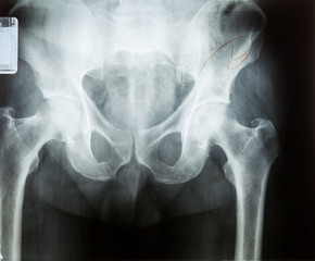 X ray MRI - Image of Spine pain and Hip bone