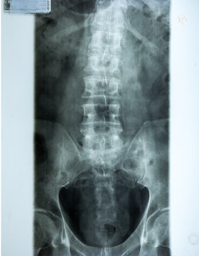 X ray MRI - Image of Spine pain and Hip bone