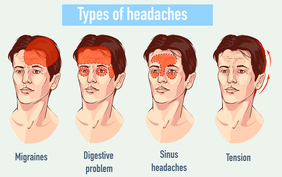 Types Of Headaches Images – Browse 7,722 Stock Photos, Vectors, and ...