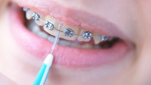 Girl in braces cleans her teeth with interdental brush for bracket system.