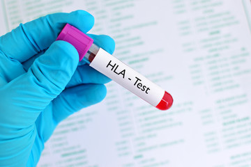 Blood sample for HLA (Human Leukocyte Antigen) test
