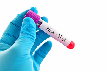 Obraz premium Blood sample for HLA (Human Leukocyte Antigen) test 