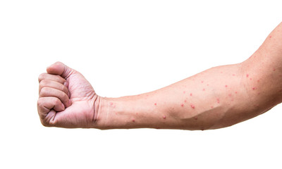   a man who having varicella blister or chickenpox