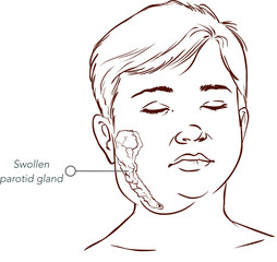 children salivary gland swelling vector illustration