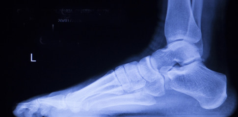 Obraz premium Foot and toes injury xray scan