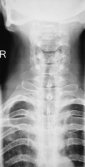 Skull neck spine shoulders xray scan