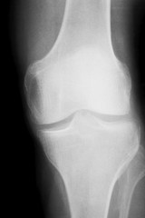 Naklejka premium Knee and meniscus injury xray scan