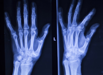 Hand fingers thumb wrist xray scan
