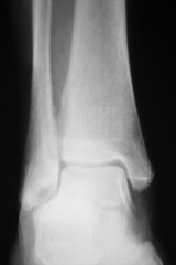 Shin leg ankle injury xray scan