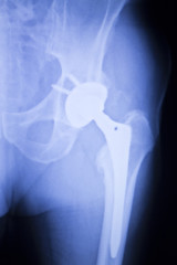 Hip replacement xray orthopedic medical scan