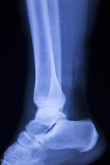 Foot heel ankle injury xray scan