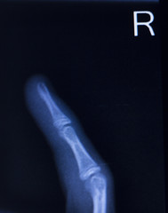 Hand fingers xray scan