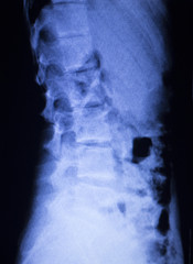Spine vertebra back injury xray scan