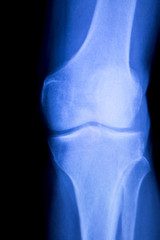 Knee and meniscus injury xray scan
