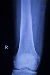 Knee and meniscus injury xray scan