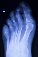Foot and toes injury xray scan