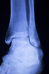 Shin leg ankle injury xray scan