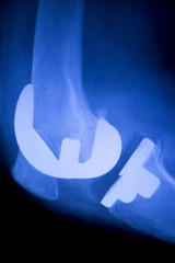 Knee orthopedic implant xray scan