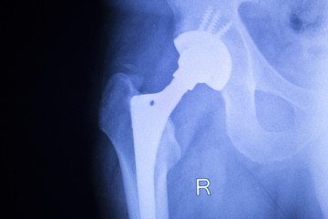 Hip joint orthopedic replacement implant