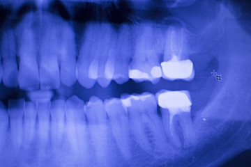 Dental teeth filling dentists xray scan