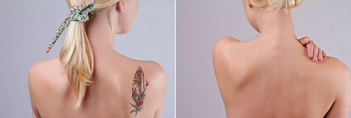 Laser tattoo removal before and after. Beautiful young woman with tattoo on her back