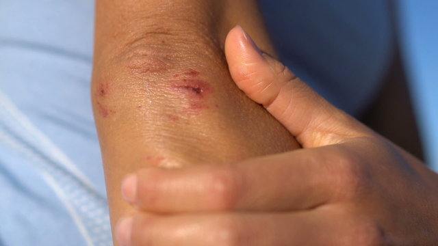 Woman with wounded elbow showing a minor skin scrapes wound. Sporty young female is touching arm. Closeup of fit lady in pain due to injury.