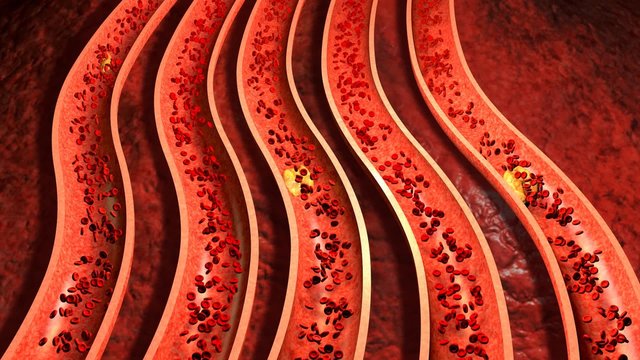 Clogged Artery with platelets and cholesterol plaque, concept for health risk for obesity or dieting and nutrition problems. Highly detailed  3D animation