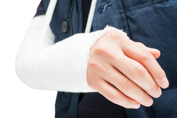 Fototapeta premium Broken elbow with medical bandage or gypsum