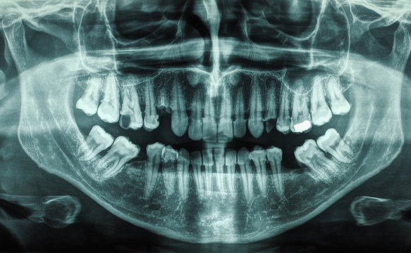 Human Teeth Xray