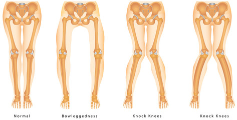 Shape of the legs - Genu varum, genu valgum 