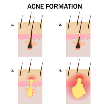Formation of acne