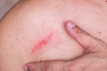Fingers embrace minor bruise on skin between shoulder and chest