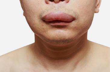 The skin around the mouth caused by an allergic reaction to medication. - obrazy, fototapety, plakaty
