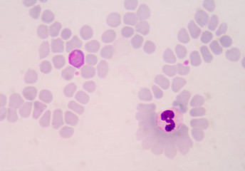 malaria