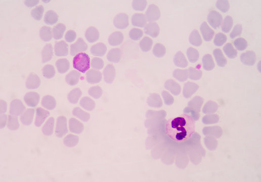 malaria