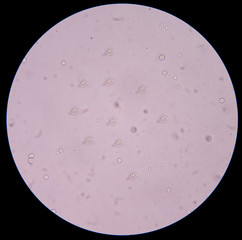 white blood cells  in urine