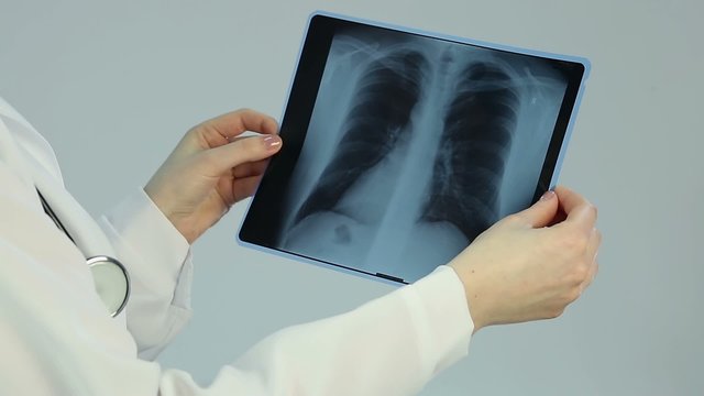 Doctor looking at pathology on chest x-ray, diagnosing patient with lung cancer